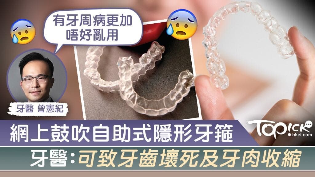 網上鼓吹自助式隱形牙箍，牙醫：嚴重可引致牙齒壞死