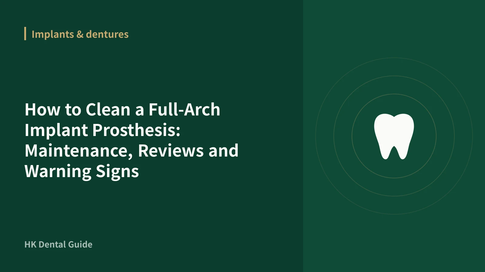 How to Clean a Full-Arch Implant Prosthesis: Maintenance, Reviews and Warning Signs