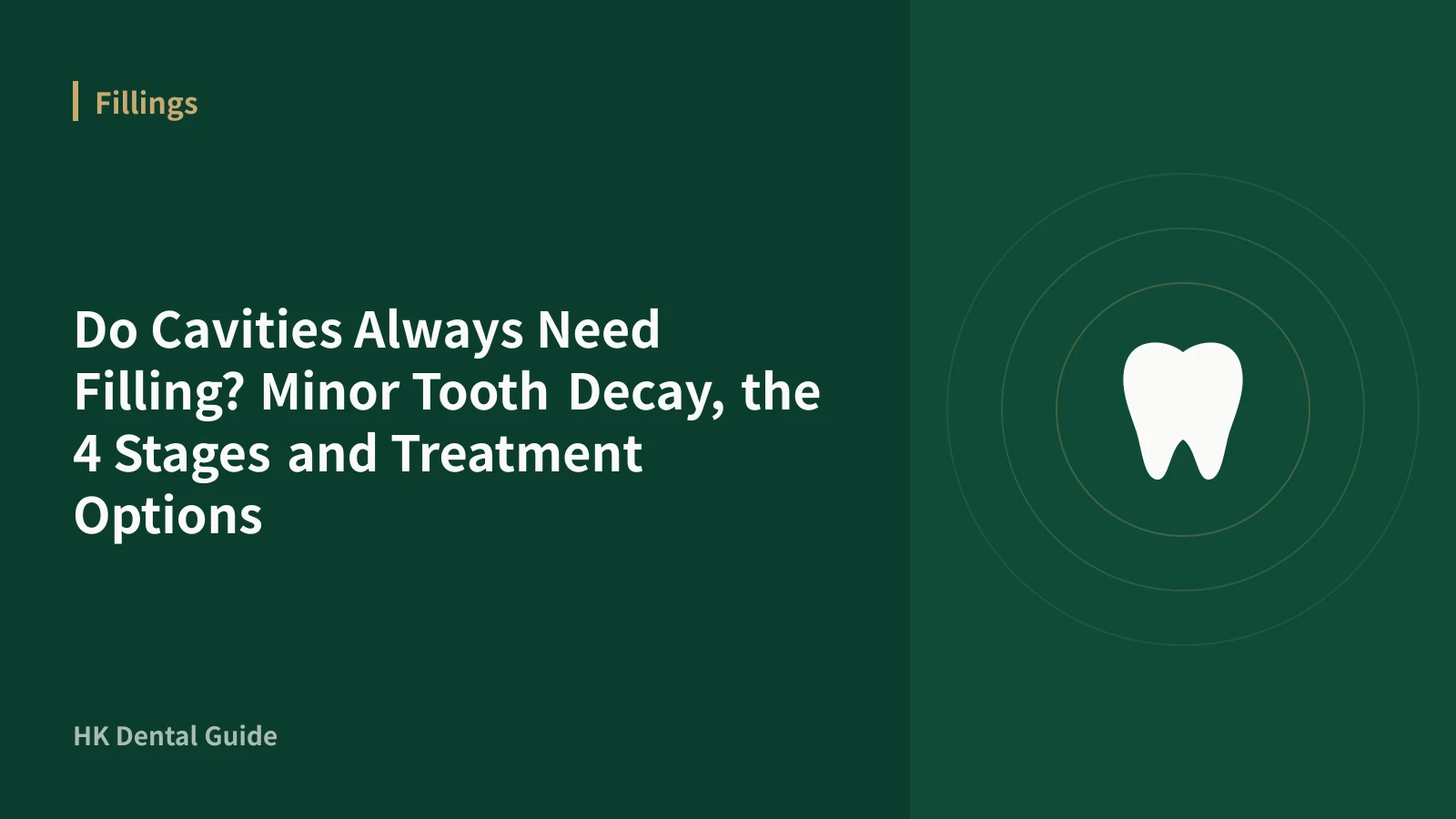 Do Cavities Always Need Filling? Minor Tooth Decay, the 4 Stages and Treatment Options