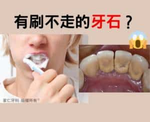 牙菌膜鈣化形成牙結石的示意圖,說明牙周病成因及超聲波洗牙的重要性