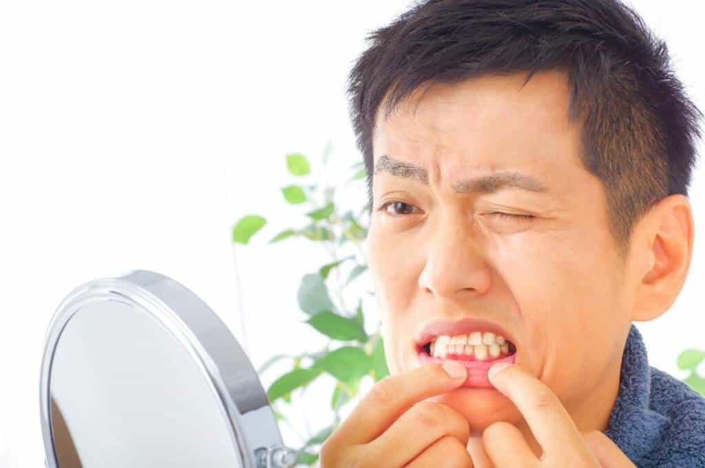 香港洗牙後牙齦恢復健康示意圖,顯示清除牙結石後牙肉狀態