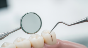 2026 香港牙科檢查裂牙症候群過程