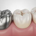銀粉 vs 樹脂補牙：2026香港牙科收費指南與材料客觀比較